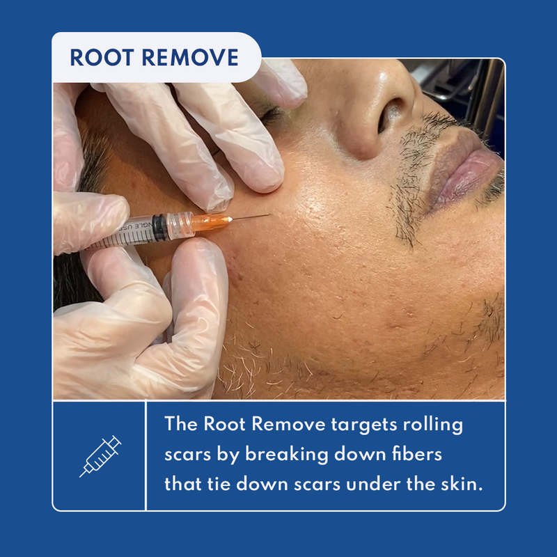 Remedy's 360° Acne Scar Treatments, Explained